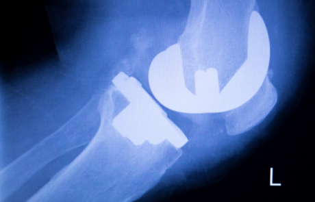 ניתוח החלפת מפרק הברך – כל מה שצריך לדעת