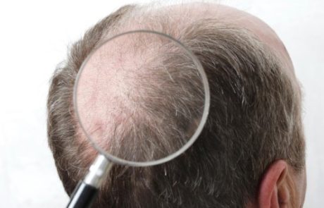 הדמיית שיער בצפון: המדריך המלא לפתרונות מתקדמים